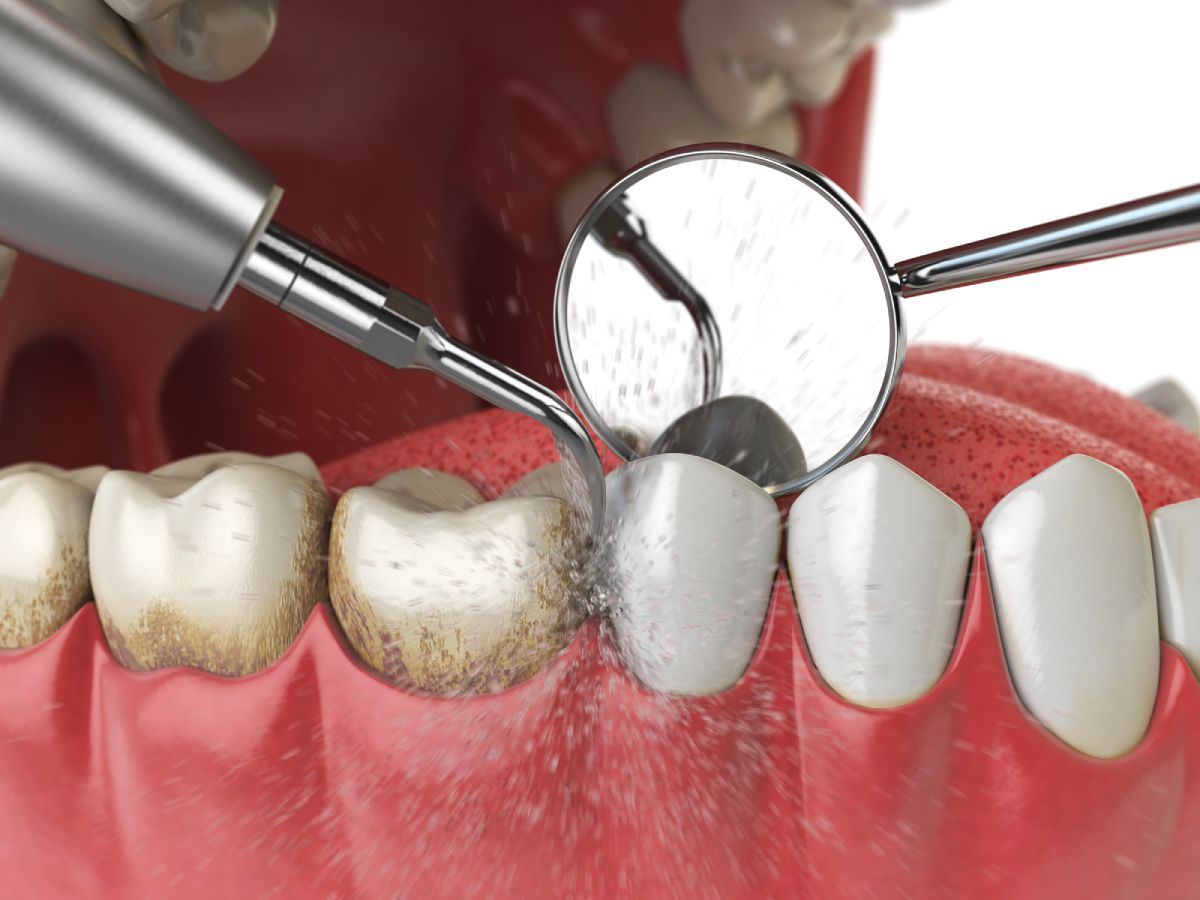 Limpiador Dental Ultrasónico